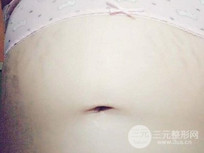 武漢一美王朝暉激光去妊娠紋真實(shí)案例，并附上前后對比圖片
