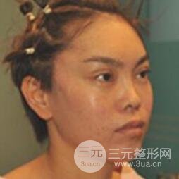 去做了埋線面b提拉術(shù)果很是不錯