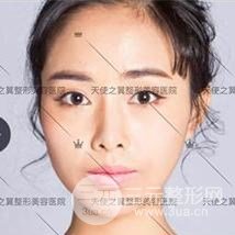 面部自體脂肪填充+隆鼻整形+雙眼皮案例，恢復(fù)果照片~