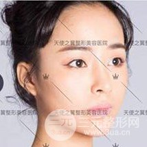 面部自體脂肪填充+隆鼻整形+雙眼皮案例，恢復(fù)果照片~