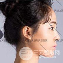 面部自體脂肪填充+隆鼻整形+雙眼皮案例，恢復(fù)果照片~