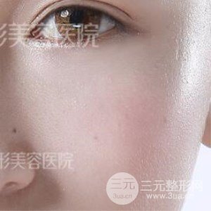 芭比雙眼皮+去眼袋案例分享，還有恢復(fù)過程照片哦~