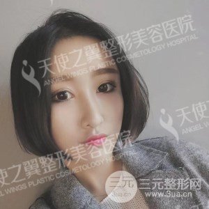 芭比雙眼皮+去眼袋案例分享，還有恢復(fù)過程照片哦~