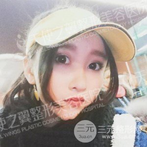 芭比雙眼皮+去眼袋案例分享，還有恢復(fù)過程照片哦~