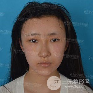 自體脂肪面部填充+全鼻金雕真實(shí)案例，恢復(fù)照片分享~