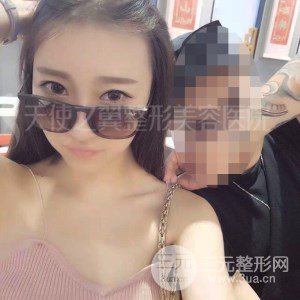 自體脂肪面部填充+全鼻金雕真實(shí)案例，恢復(fù)照片分享~