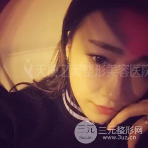 自體脂肪面部填充+全鼻金雕真實(shí)案例，恢復(fù)照片分享~