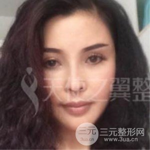 隆鼻整形修復(fù)+自體脂肪詳細(xì)部填充案例分享~