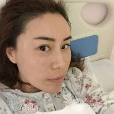 武漢美侖陳遠(yuǎn)海自體脂肪填充全臉案例，附上前后對比圖片