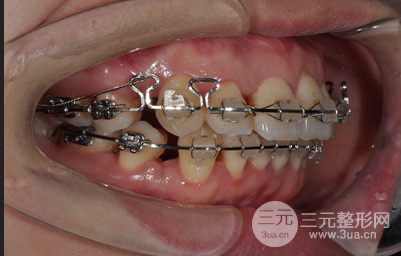 昆明醫(yī)科大學附屬口腔醫(yī)院黎明牙齒矯正果分享