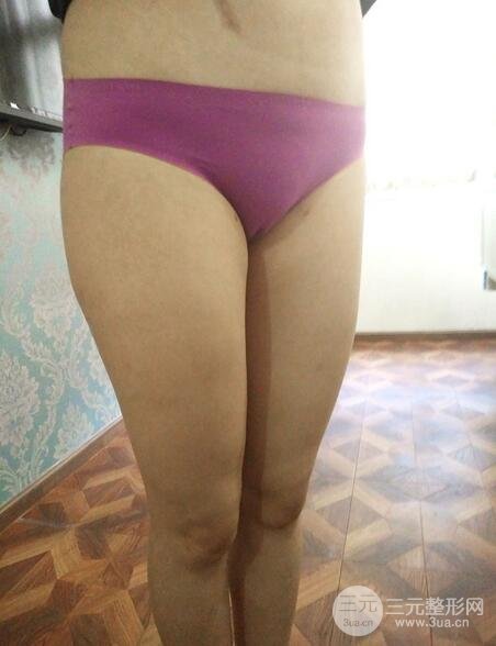 大腿抽脂后的恢復(fù)過程，真人案例真實分享