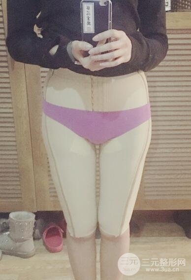 大腿抽脂后的恢復(fù)過程，真人案例真實分享