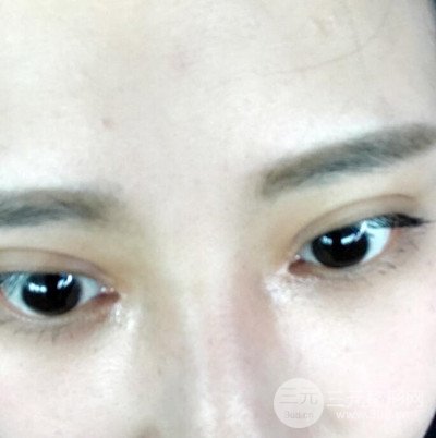 雙眼皮多項整形整形案例：切開雙眼皮+開內(nèi)眼角前后對比圖