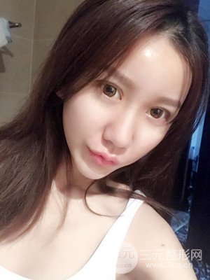 上海原辰自體脂肪填充案例，附上恢復(fù)過程以及對(duì)比圖片