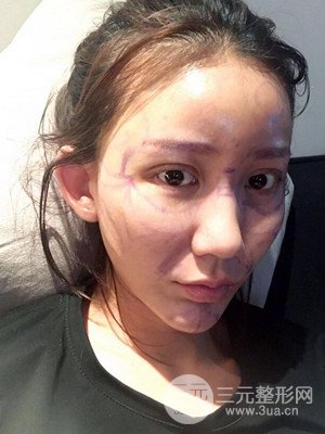 上海原辰自體脂肪填充案例，附上恢復(fù)過程以及對(duì)比圖片