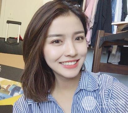 南京康美陳小劍做的雙眼皮案例果真實(shí)的分享給你們！