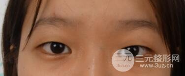南京康美陳小劍做的雙眼皮案例果真實(shí)的分享給你們！