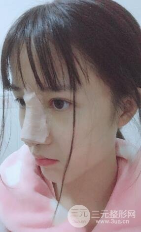 柏麗李勁良假體隆鼻案例果分享！小巧精致又立體~