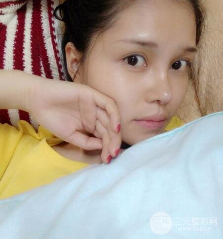 鼻頭縮小術(shù)過程圖，鼻頭縮小恢復(fù)日記