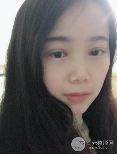 湘雅龍劍虹雙眼皮案例恢復日記分享