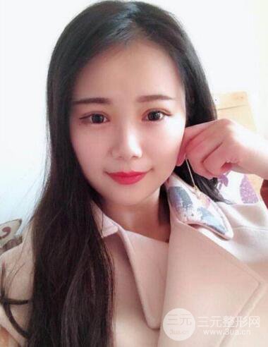 湘雅龍劍虹雙眼皮案例恢復日記分享