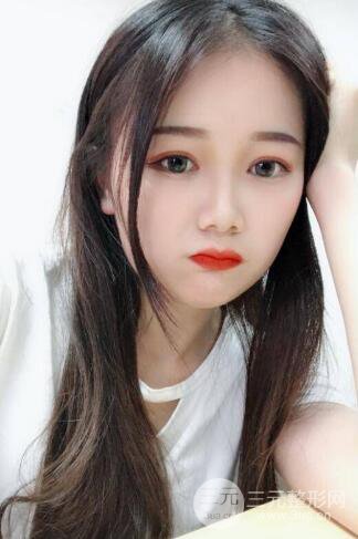 湘雅龍劍虹雙眼皮案例恢復日記分享