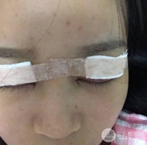 芭比電雙眼皮多項整形術(shù)后分享，雙眼皮拯救死魚眼！
