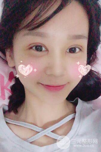 芭比電雙眼皮多項整形術(shù)后分享，雙眼皮拯救死魚眼！