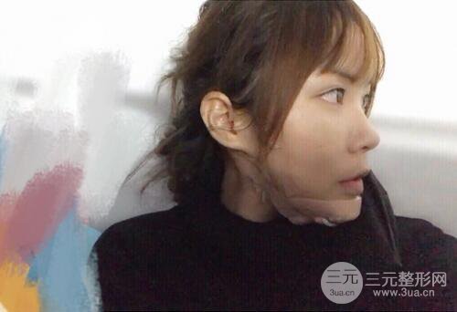 自體脂肪填充全臉基本換臉，改臉型不只是磨骨才能做到！