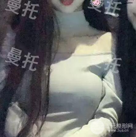 分享我的曼托隆胸圖片