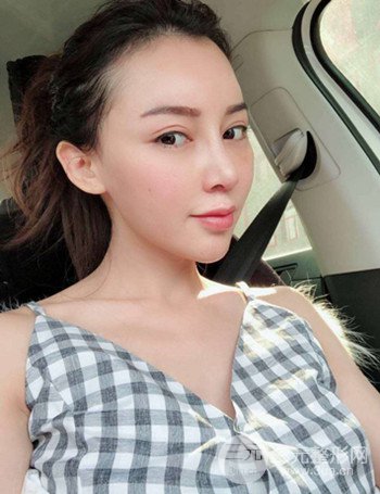 上海隆鼻失敗手術(shù)修復(fù)果超乎想象、前后對(duì)比照片分享