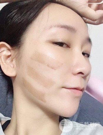 面部埋埋蛋白線.提升改良皮膚松弛，立現(xiàn)小V臉