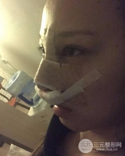 武漢美侖陳遠(yuǎn)海假體隆鼻案例，恢復(fù)過程分享~