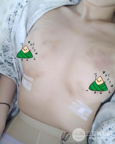 武漢同濟自體脂肪隆胸案例，恢復過程前后對比圖分享~