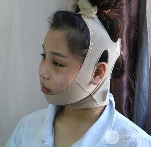 【下頜角+顴骨+下巴】全臉磨骨整形，術(shù)后的我人生開掛了！