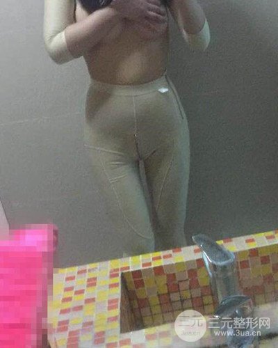 廣州韓妃大腿吸脂案例，恢復(fù)過(guò)程前后對(duì)比圖片分享~