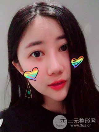 深圳臻希美詳細(xì)部自體脂肪填充果對比超明X