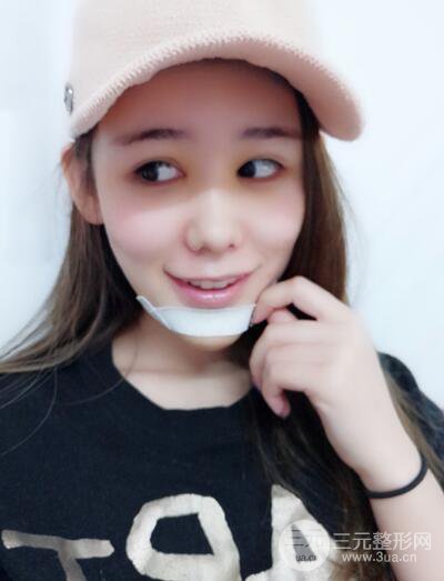 全臉自體脂肪填充，填充不飽滿(mǎn)還可以瘦臉_真人案例