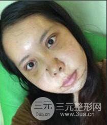 顴骨磨骨改臉型過(guò)程和恢復(fù)步驟照片（圖）