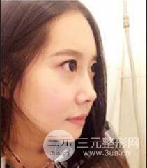 顴骨磨骨改臉型過(guò)程和恢復(fù)步驟照片（圖）