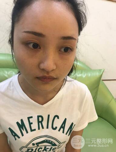 九院曹衛(wèi)剛自體脂肪面部填充案例