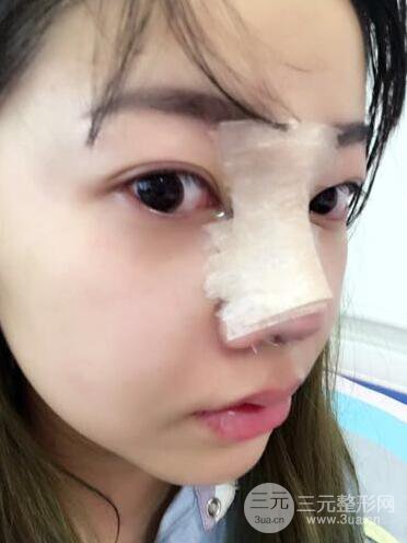 西安西京醫(yī)院整形科潘勇隆鼻整形案例以及前后對比圖展示~