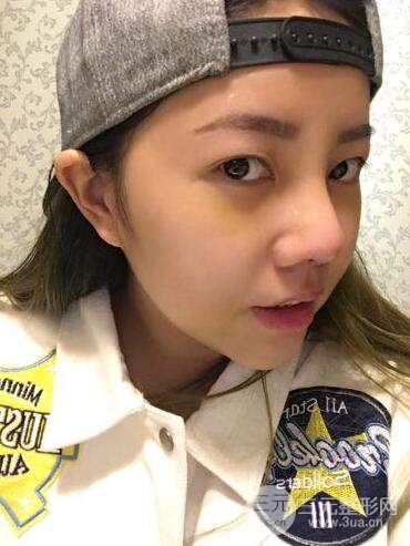 西安西京醫(yī)院整形科潘勇隆鼻整形案例以及前后對比圖展示~