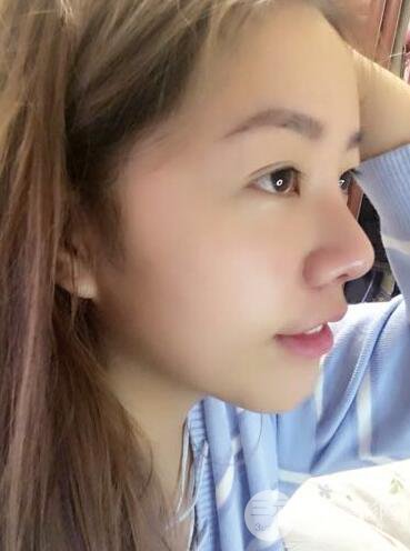 西安西京醫(yī)院整形科潘勇隆鼻整形案例以及前后對比圖展示~