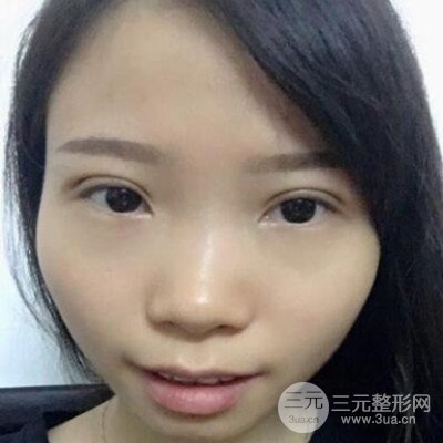 張永義醫(yī)生全切雙眼皮案例前后對比圖