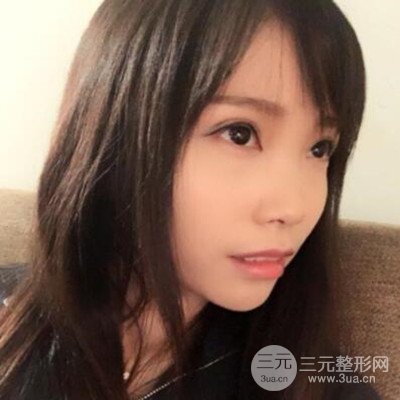 張永義醫(yī)生全切雙眼皮案例前后對比圖