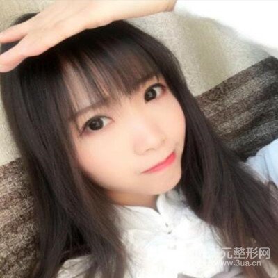 張永義醫(yī)生全切雙眼皮案例前后對比圖