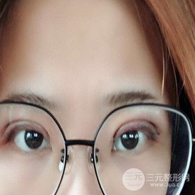 無錫菲尚徐火旺雙眼皮案例前后對比圖