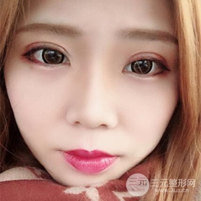 無錫菲尚徐火旺雙眼皮案例前后對比圖