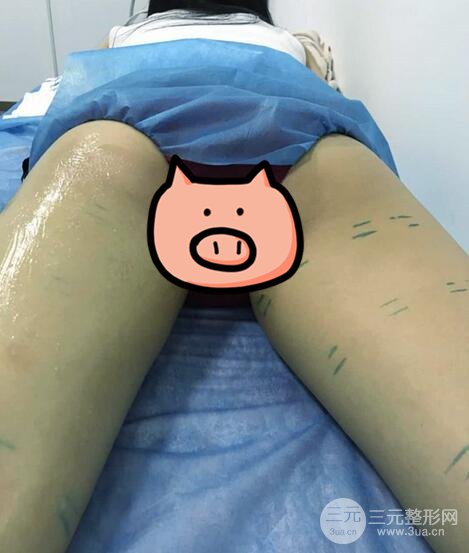 曹衛(wèi)剛大腿吸脂案例恢復圖片記錄分享